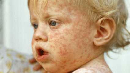 Measles 