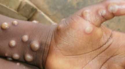 monkeypox